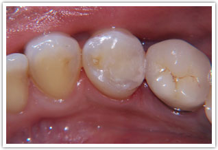 After image of Tooth colored resin filling