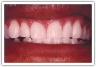 after teeth whitening