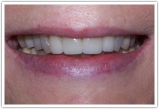 After front tooth dental treatment