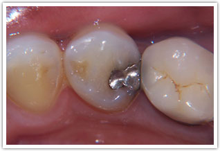 Before image of old failing bridge with very small teeth