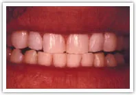 before teeth whitening