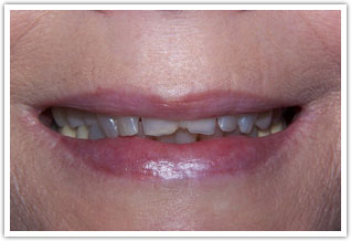 Before front tooth dental treatment