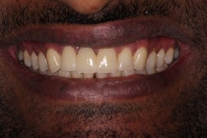 After photo of a fixed bridge on upper front teeth