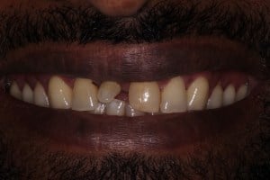 Before photo of a fractured upper front tooth and damaged neighboring tooth