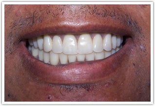 After pic of complete upper and lower dentures