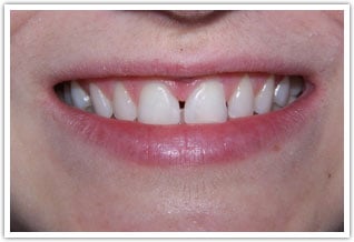 After image of dental bonding to decrease the size of large space between front teeth