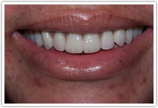 After new upper denture procedure