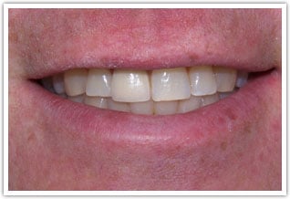After one crown on front tooth procedure
