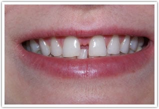 Before tooth bonding for large space between front teeth