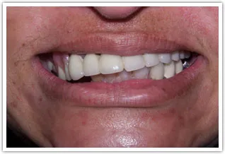 Before image of a poorly fitting upper denture