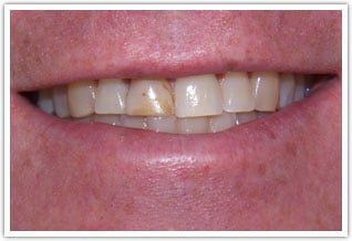 Before one crown on front tooth treatment
