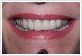 After porcelain veneers on front four teeth at Markowitz Dental of Washington DC