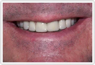 After image of dental crowns to restore function and esthetics