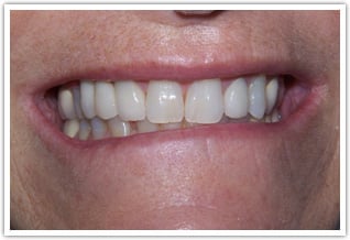 Metal free porcelain fused to zirconia replacement bridge - after