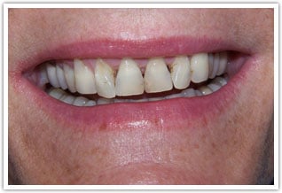 Image of unattractive front teeth