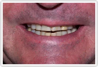 Before image of a patient's dark and severely worn teeth