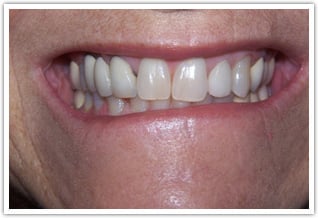 Metal free porcelain fused to zirconia replacement bridge - before