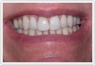After image of a veneer on one front tooth procedure