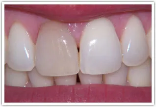 Before Image of a severely discolored front tooth