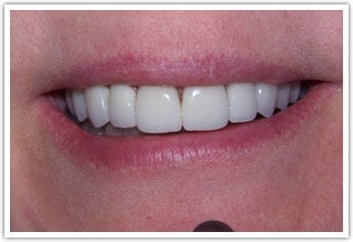 After image of ten upper porcelain veneers treatment
