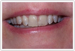 Before image of dark, crooked, rotated teeth