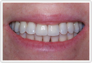 1 Porcelain Veneer and 1 Porcelain Crown