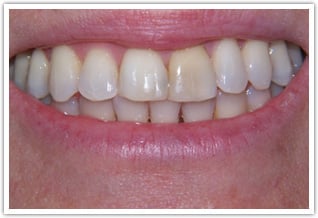 1 Porcelain Veneer and 1 Porcelain Crown