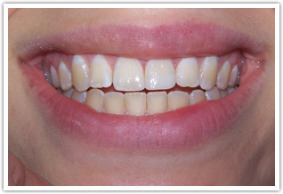 Tooth Colored Bondings Placed on 3 Teeth - after