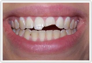 Tooth Colored Bondings Placed on 3 Teeth - before