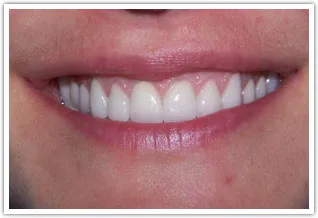 After image of porcelain fused to zirconia crowns for severely worn teeth