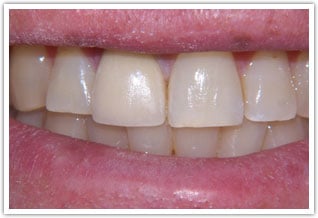 After one crown on front tooth procedure | Markowitz Dental of Washington DC
