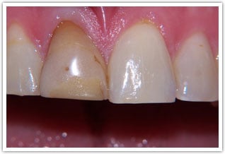Close up photo of s discolored, worn front tooth