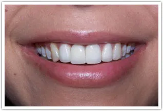 After image if one dental implant and crowns
