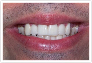 After porcelain veneers on front four teeth treatment