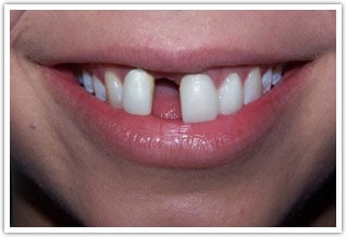 Before image of missing tooth and poor esthetics