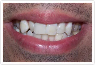  Before photo of severe crowding of teeth