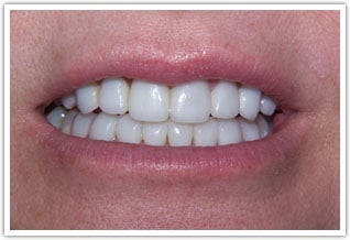 After porcelain veneers procedure for porcelain veneers