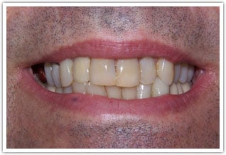 After dental Implant and dental crown procedure