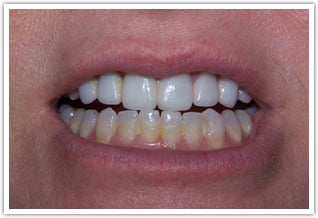 Before image of severely discolored lower teeth