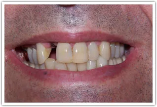 Before image of missing tooth