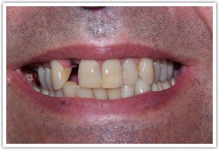 Before image of missing tooth