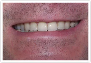 After photo of ceramic crowns on front two teeth due to fractured front teeth