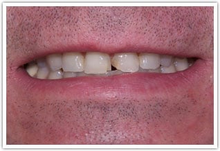 Before photo of fractured front teeth