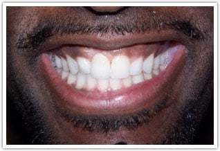 After dental implant and crown of front tooth treatment