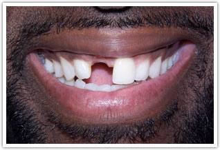 Before image of missing tooth procedure