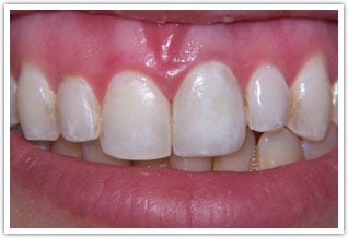 After photo of dental crowns on front tooth due to severely discolored front tooth