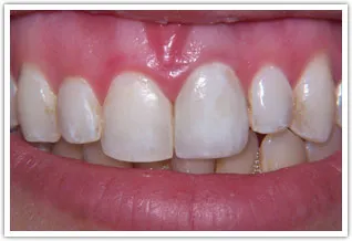 After photo of dental crowns on front tooth due to severely discolored front tooth