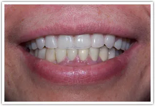 After image of upper denture and lower crowns.