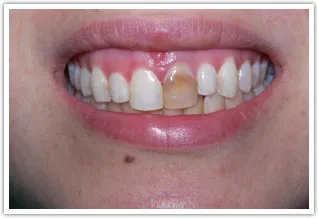 Before photo of severely discolored front tooth