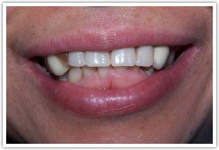 Before photo of uneven teeth, poor fitting dental bridge